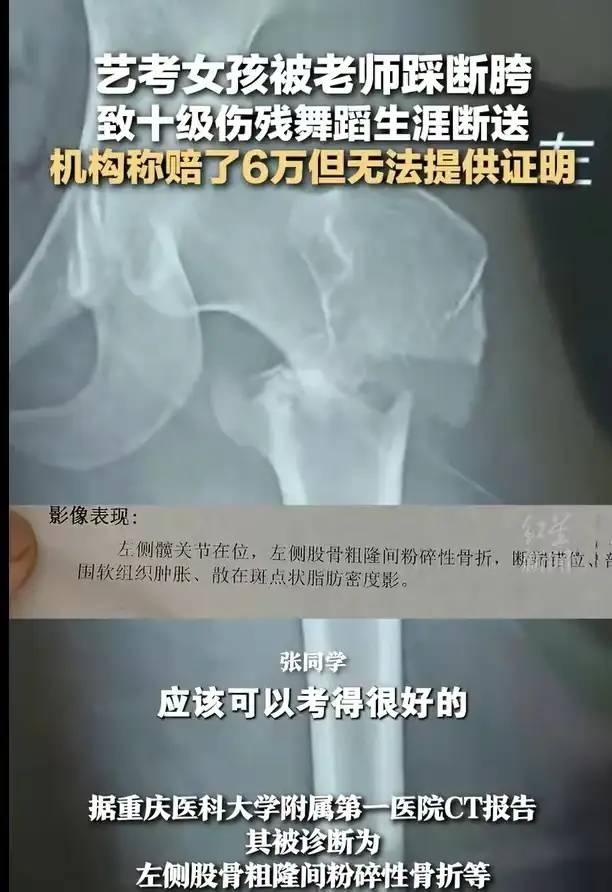震惊！重庆19岁女生被舞蹈老师压断腿，导致十级伤残！